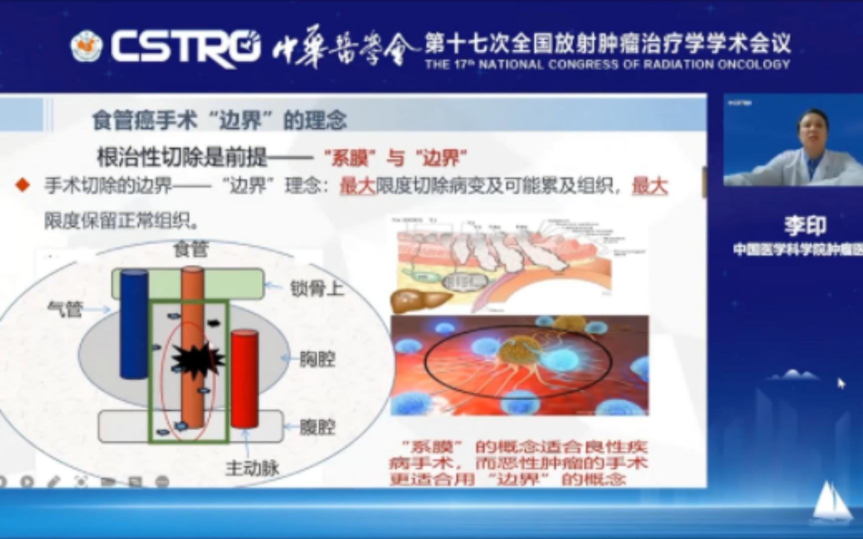 食管癌新辅助治疗的胸外科视角李印 (中国医学科学院肿瘤医院)哔哩哔哩bilibili