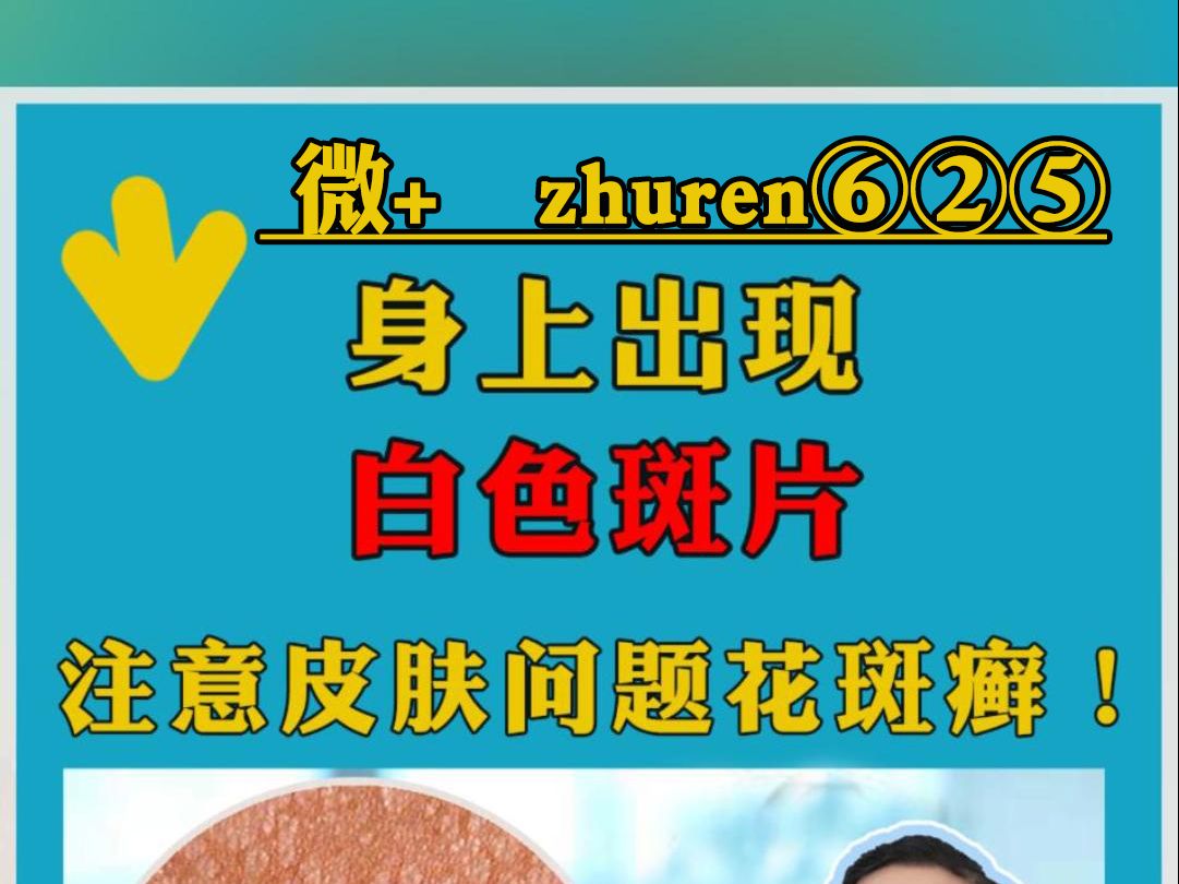 广东全民白癜风筛查:身上白色斑片皮肤问题,不一定是白癜风可能是