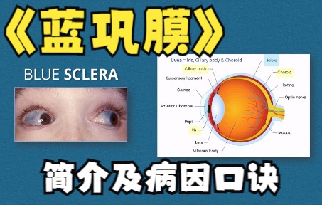 【中英双字】【蓝巩膜:简介及病因口诀】 Blue Sclera: Pathology its Causes and mnemonic哔哩哔哩bilibili