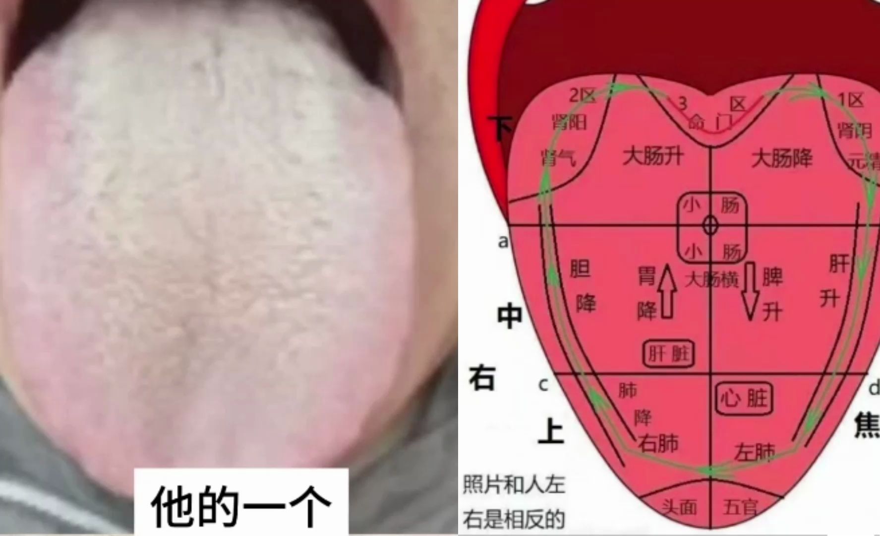 舌诊分析——淡红舌,舌苔黄腻,内热外寒,肝郁化热