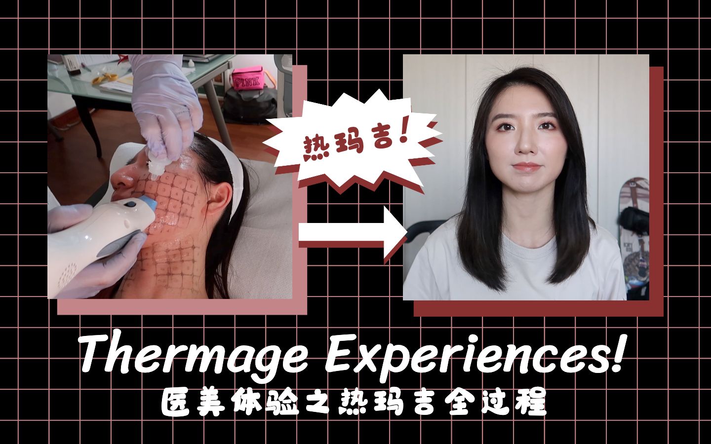 热玛吉Thermage Experience经验分享 | 理性种草 | 热玛吉前后日常保养分享 | 护肤分享哔哩哔哩bilibili