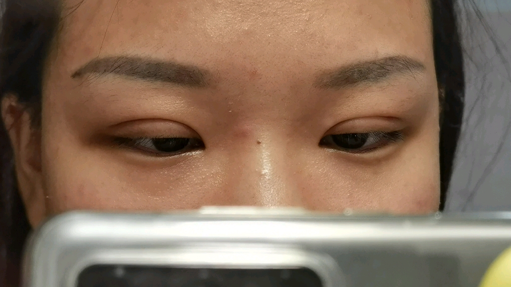 肿眼泡埋线26天啦和14天真的有差距咩小作坊做眼睛的魔幻经历