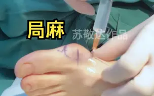 Download Video: 【苏敬达】第一视角，大脚骨手术麻醉居然是这样的！！！！