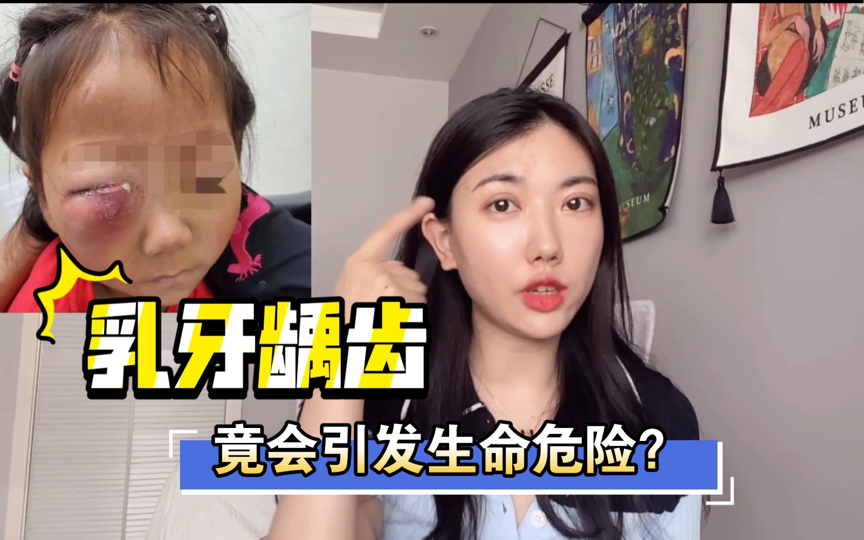 乳牙龋齿为什么一定要治疗?宝宝易被忽视的危险信号|治疗时机哔哩哔哩bilibili