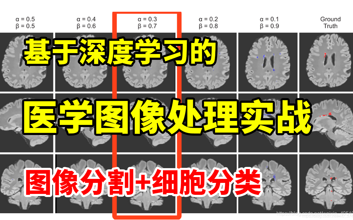 【医学图像处理实战】基于深度学习的医学图像处理实战项目,计算机博士精讲肝脏肿瘤分割及医学细胞分类实战,原理详解+项目实战,看完就能跑通!...