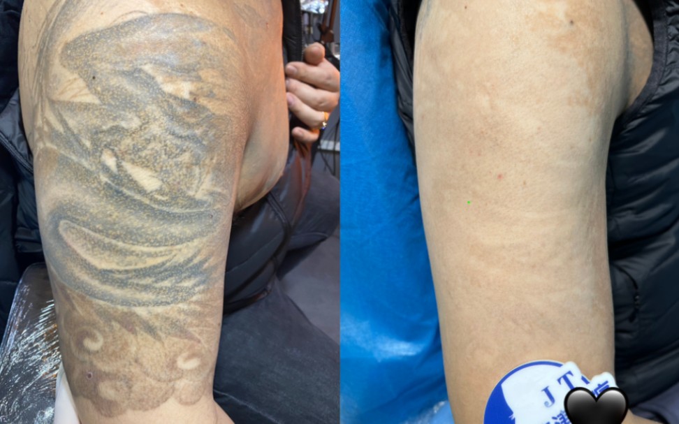 老哥上臂图腾纹身清洗3次对比记录,本次洗完毕业