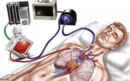 [图]《ECMO》神奇的“魔肺（ECMO）”让生命重新绽放！