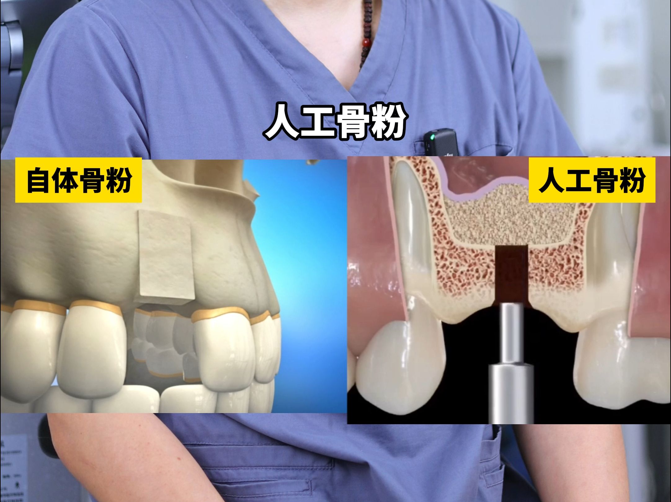 𐟔做种植牙要植骨?快来了解人工骨粉的秘密!哔哩哔哩bilibili