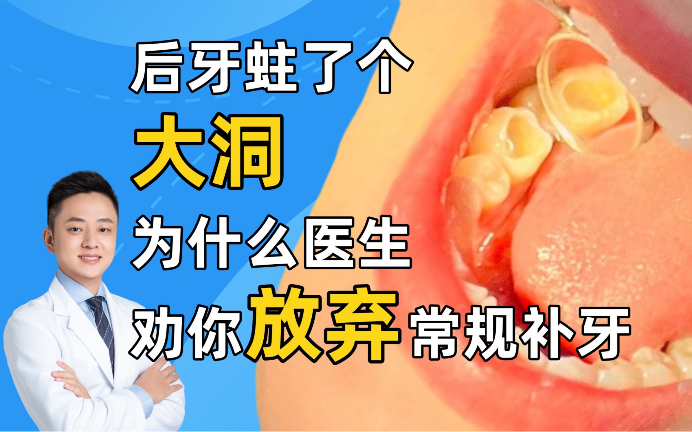 后牙蛀了个又大又深的洞,为什么医生劝你放弃常规树脂补牙,改做嵌体?哔哩哔哩bilibili