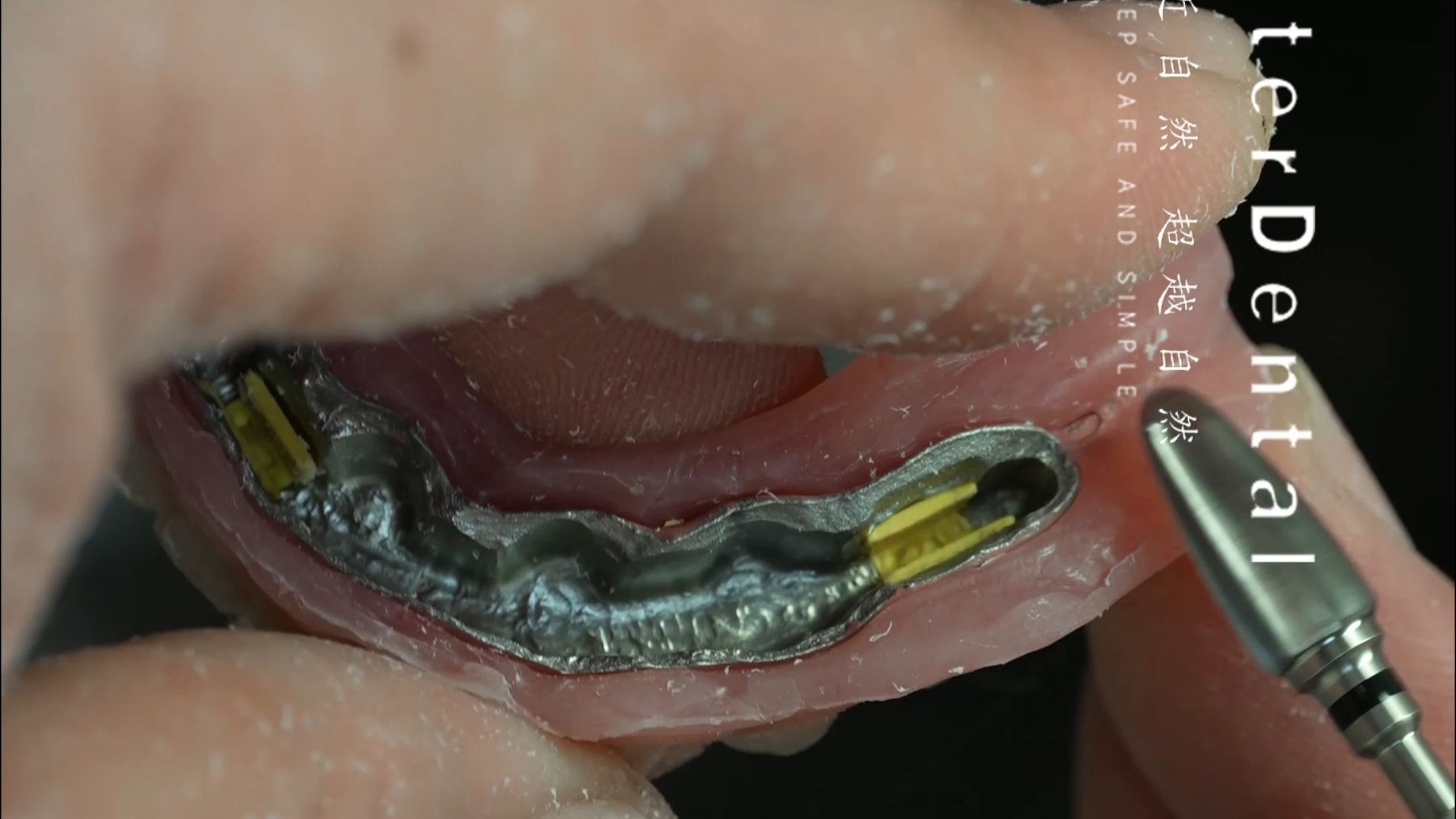 杆卡式种植覆盖义齿