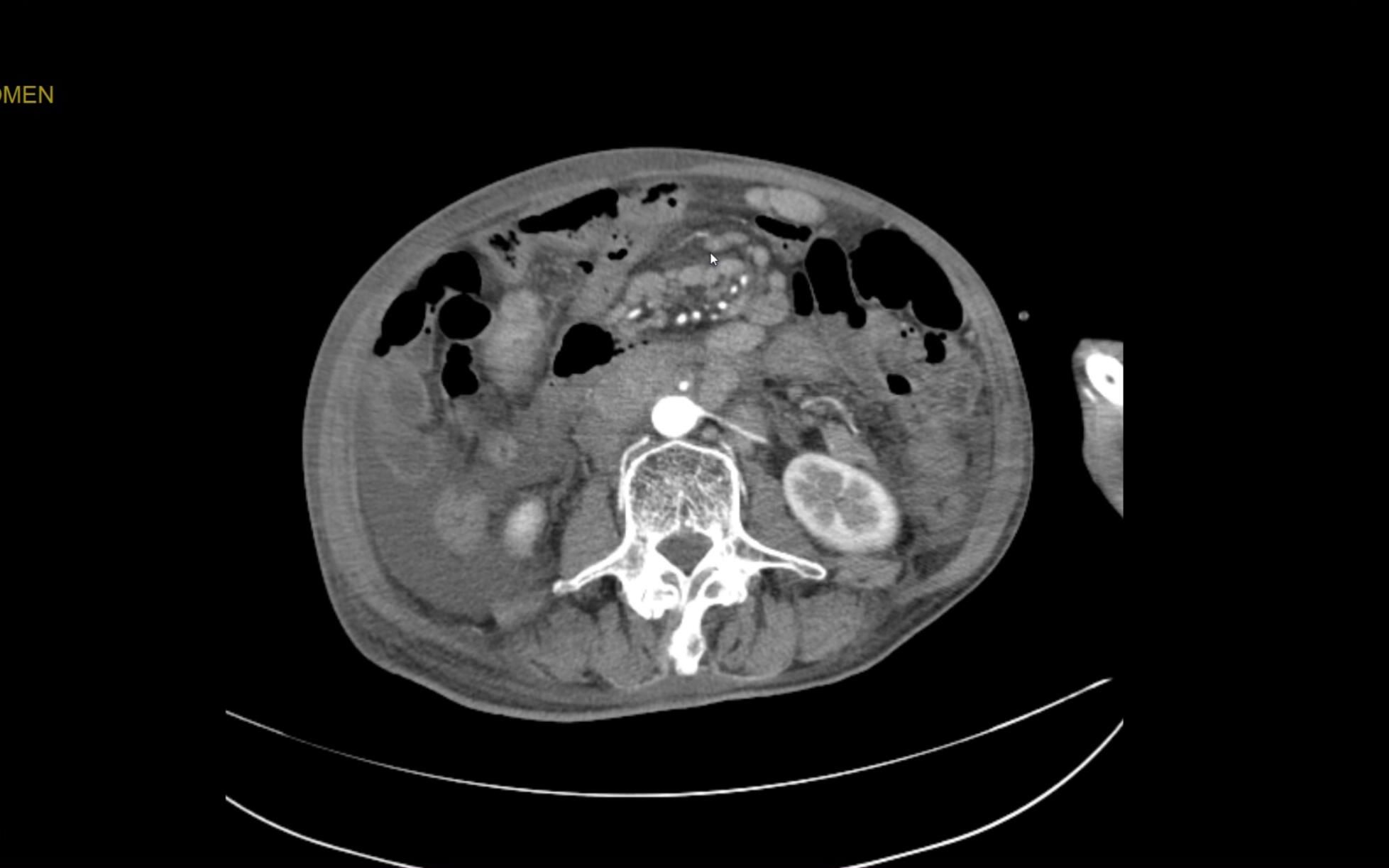 癌症晚期患者在ct上是什么样子的