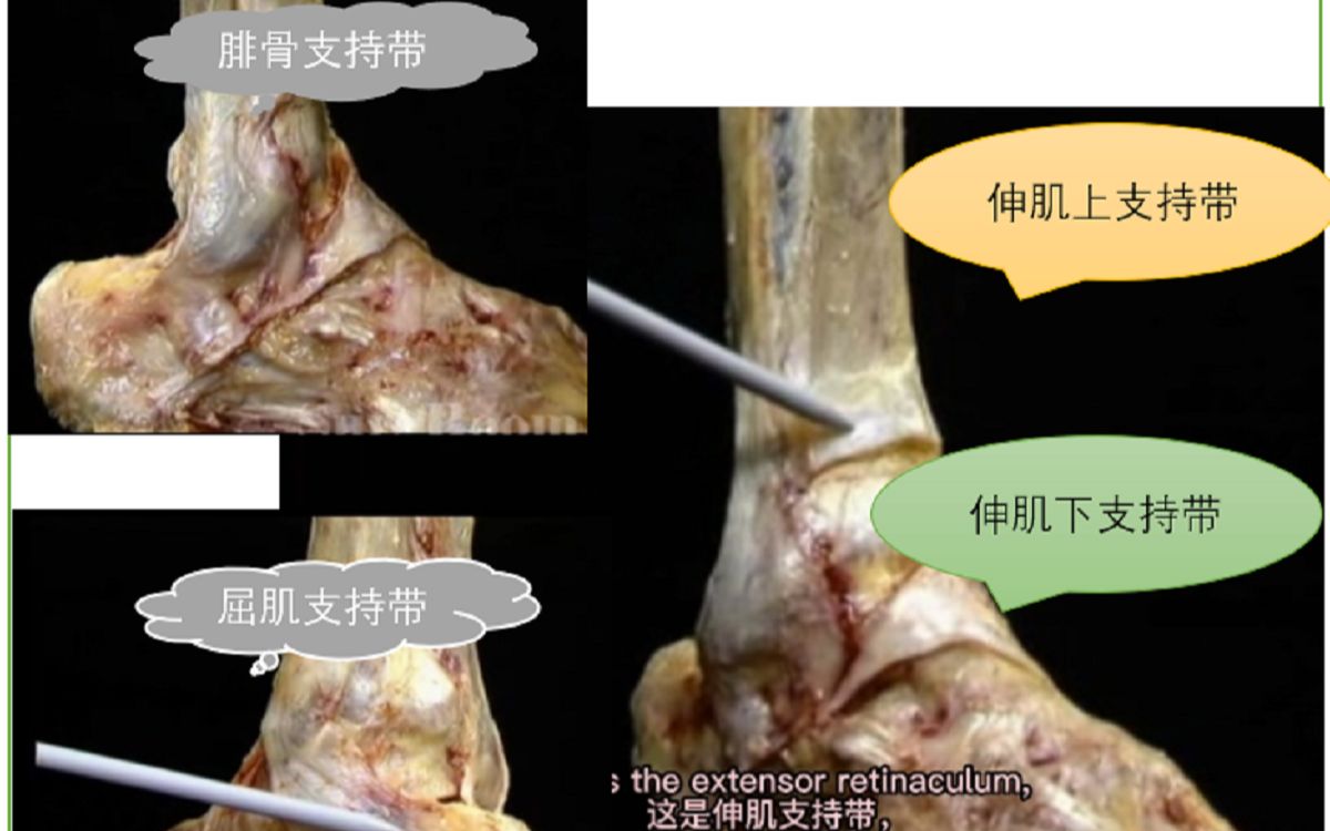 【双语字幕】艾氏解剖学伸肌和屈肌支持带(下肢22)哔哩哔哩bilibili