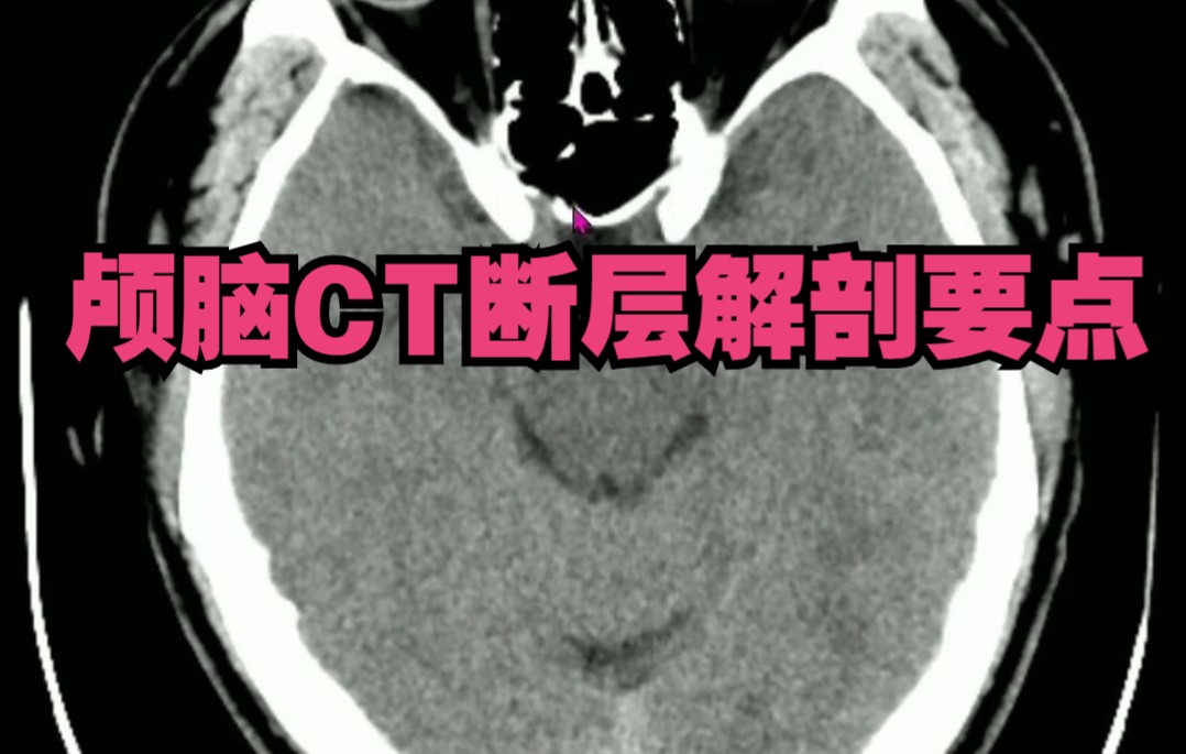 颅脑CT断层解剖基础,3分钟认识颅脑CT关键解剖位置.哔哩哔哩bilibili