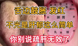 Download Video: 舌边鼓胀发红，不光是肝郁这么简单，你别说疏肝无效了！