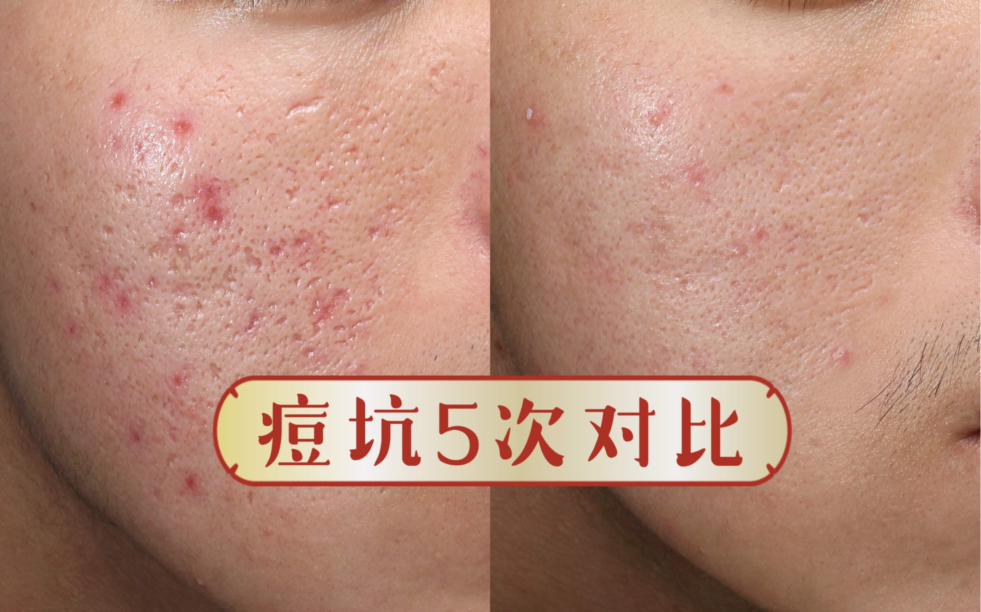 痘坑修复,5次综合激光的前后对比