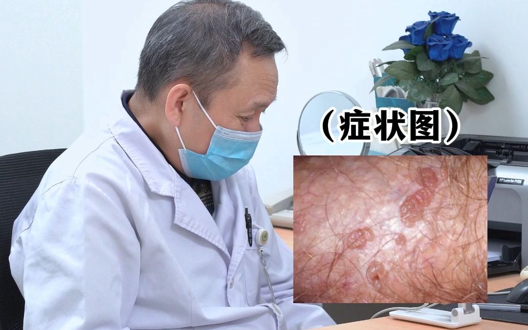 尖锐湿疣激光后却变多,正确应对方法要掌握