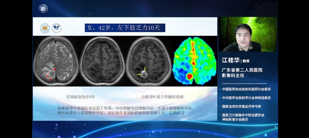 颅脑疾病磁共振征像一池征哔哩哔哩bilibili