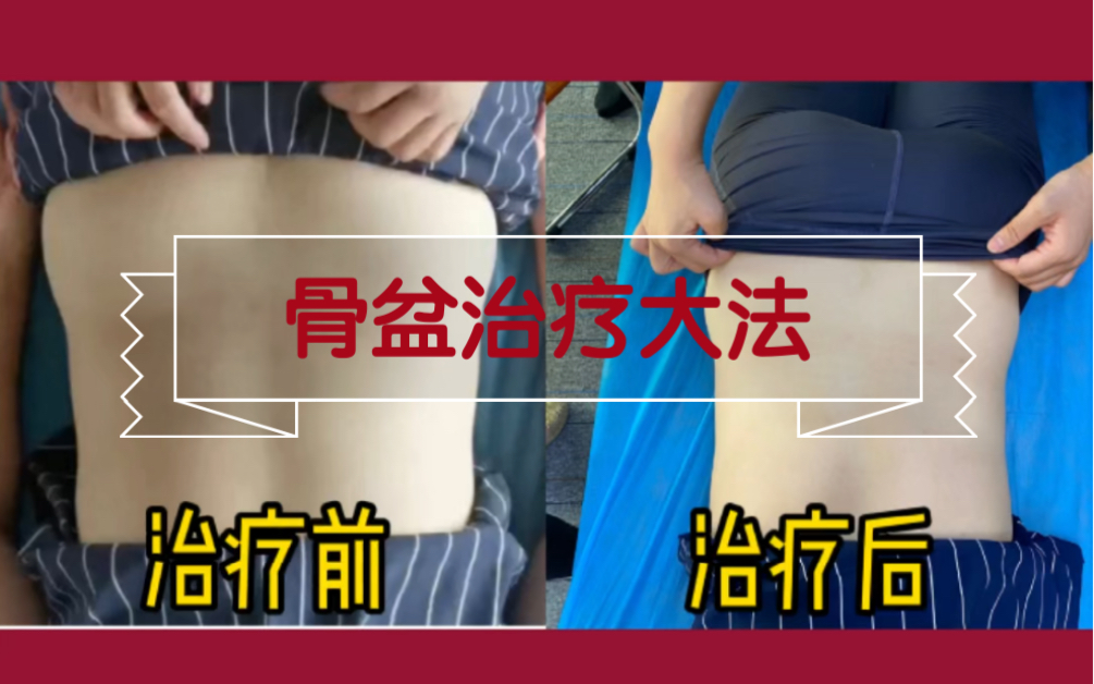 骨盆高低不平?腰上赘肉一边多一边少?一招教你轻松解决!哔哩哔哩bilibili