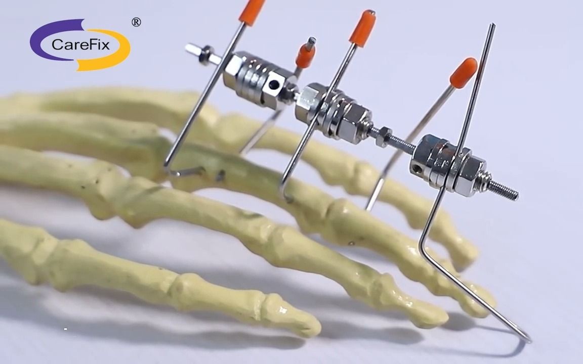 手部环式外固定支架构型