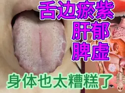 Télécharger la video: 舌边瘀紫，肝郁，脾虚，身体也太糟糕了