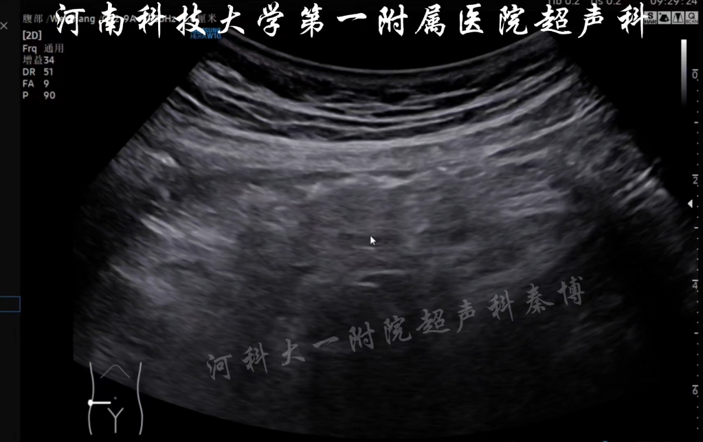 即兴病例分享 阑尾炎超声扫查