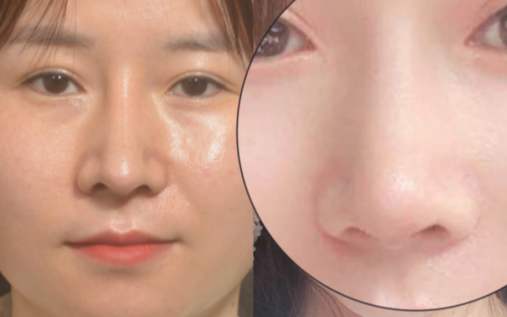 鼻假体显形修复自然妈生鼻