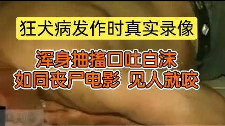 狂犬病发作时真实录像,浑身抽搐口吐白沫,如同丧尸电影活死人,见人就