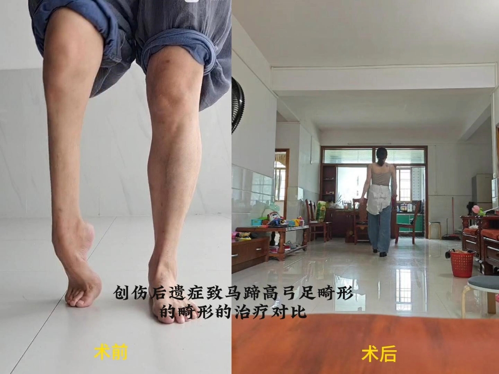 创伤后遗症致马蹄高弓足畸形的治疗对比,术后8个月恢复良好的行走功能