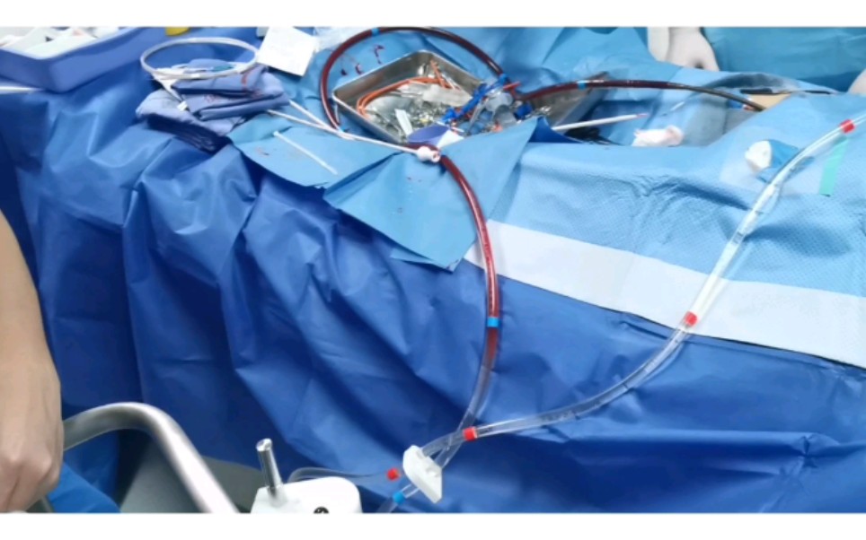 ecmo(体外膜肺氧合)之引血篇.
