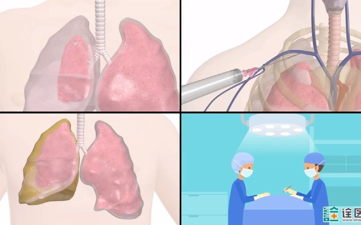 什么情况下需要做胸腔闭式引流?哔哩哔哩bilibili