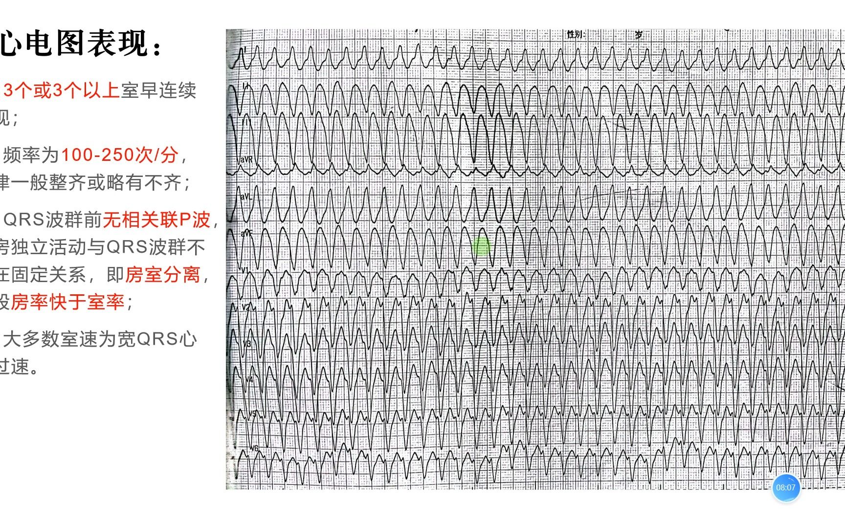 心电基础(三)之室性心律失常(室早、室速、室扑以及室颤)哔哩哔哩bilibili