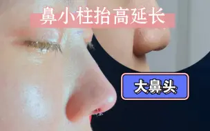 Download Video: 大鼻头、鼻翼外扩踏平，鼻基底凹陷，怎么让鼻子更立体自然？鼻小柱抬高延长