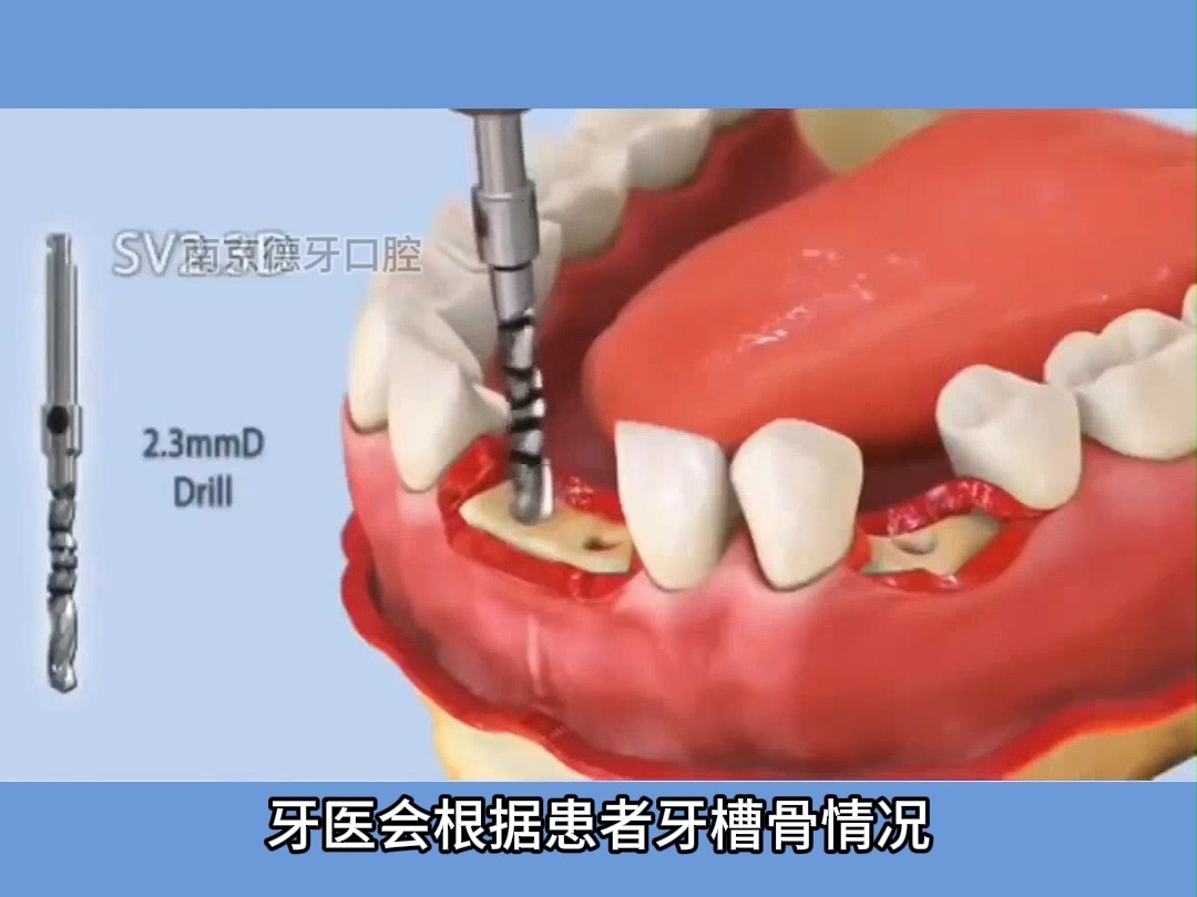 种植牙过程中骨粉是怎么填充的?哔哩哔哩bilibili