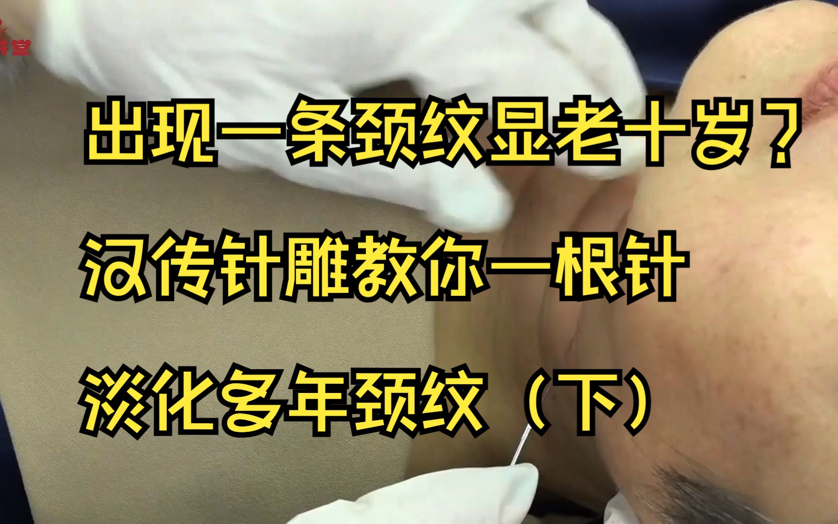 出现一条颈纹显老十岁?汉传针雕教你一根针淡化多年颈纹(下)