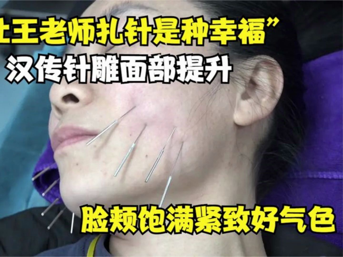 中医美容:“让王老师扎针是种幸福”汉传针雕面部提升,脸颊饱满紧致好气色 王瑞雪汉传针雕!哔哩哔哩bilibili