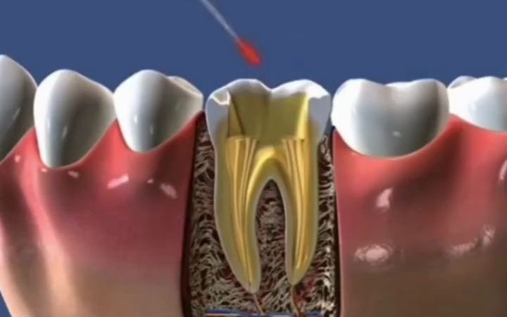 爱牙网:3D根管治疗演示VS真人根管治疗演示哔哩哔哩bilibili