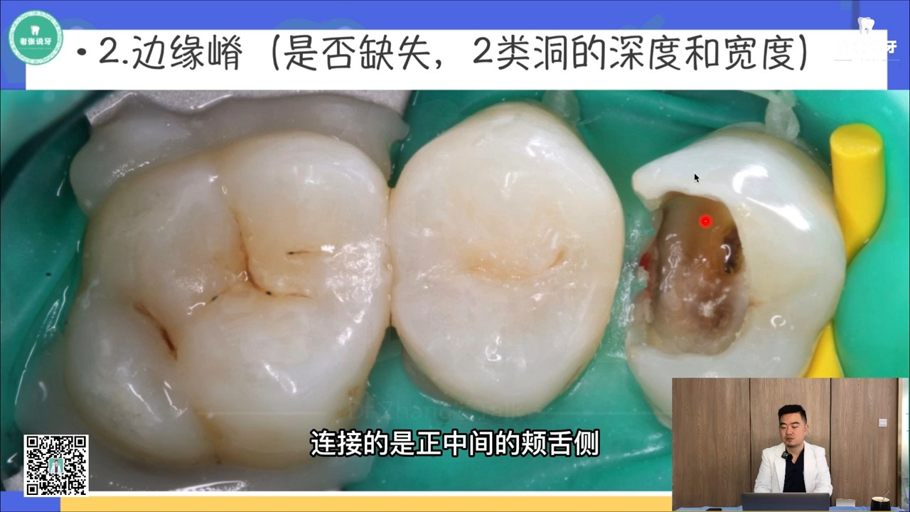后牙嵌体预备嵌体设计理论 1-2