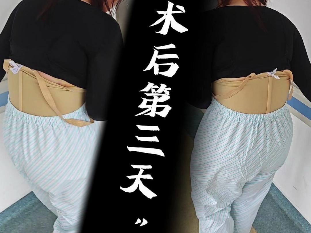 腹壁整形记录:术后3天