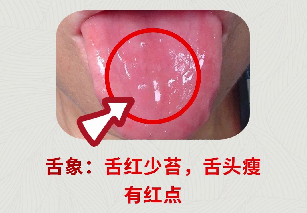 舌诊分析:7种典型肝郁舌象,对照你是第几种?哔哩哔哩bilibili