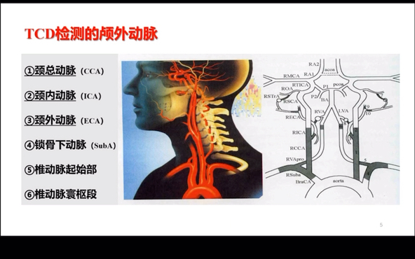 经颅多普勒 TCD 科普 脑血管哔哩哔哩bilibili