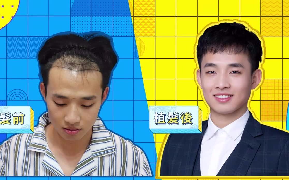 [图]植髮前後對比，術前術後效果變化驚人！Yonghe hair transplant