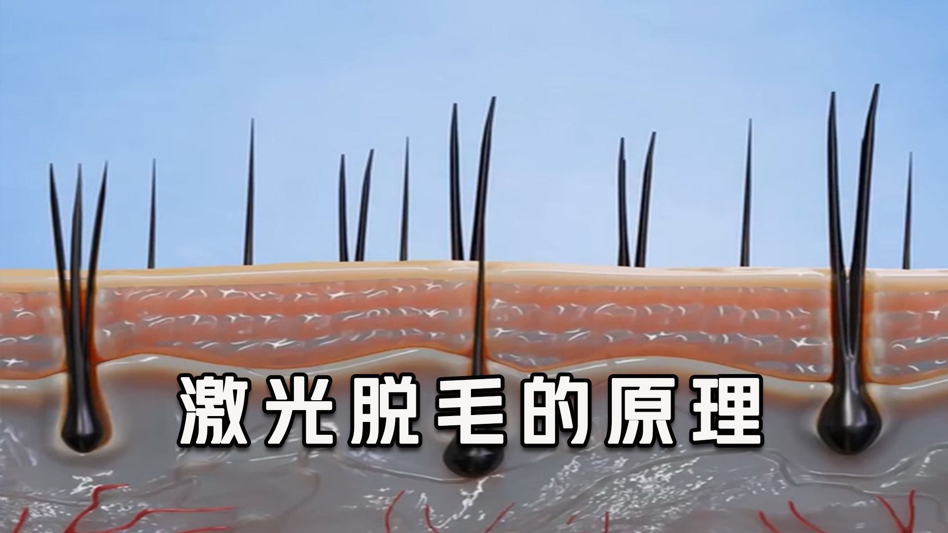 为什么激光脱毛那么贵