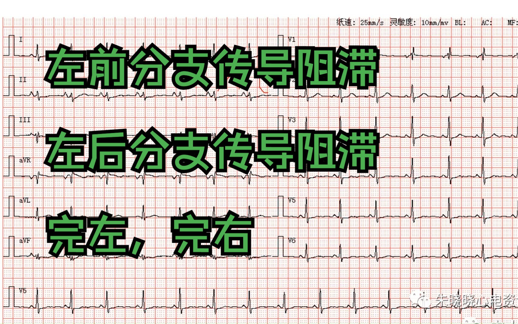 【心电图学习2】|左前分支阻滞,左后分支阻滞,完左,完右哔哩哔哩bilibili