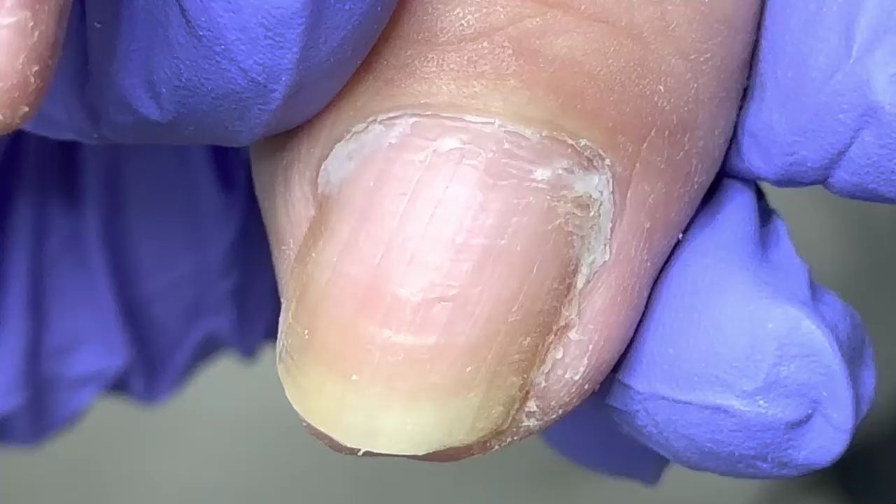 歪歪斜斜的脚趾甲,指甲深内嵌