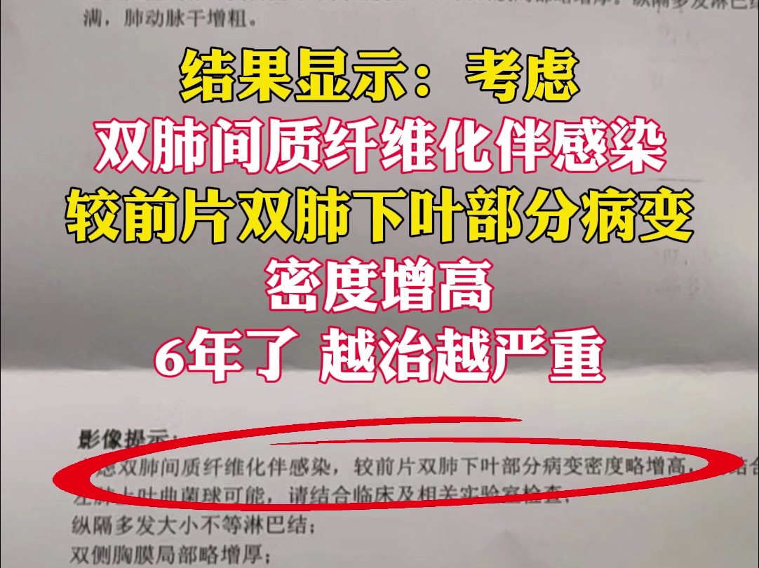 双肺间质纤维化,6年了,第一次看到好转哔哩哔哩bilibili