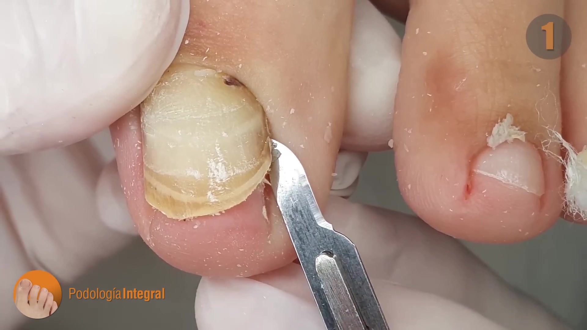 指甲垂直生长和早期真菌病