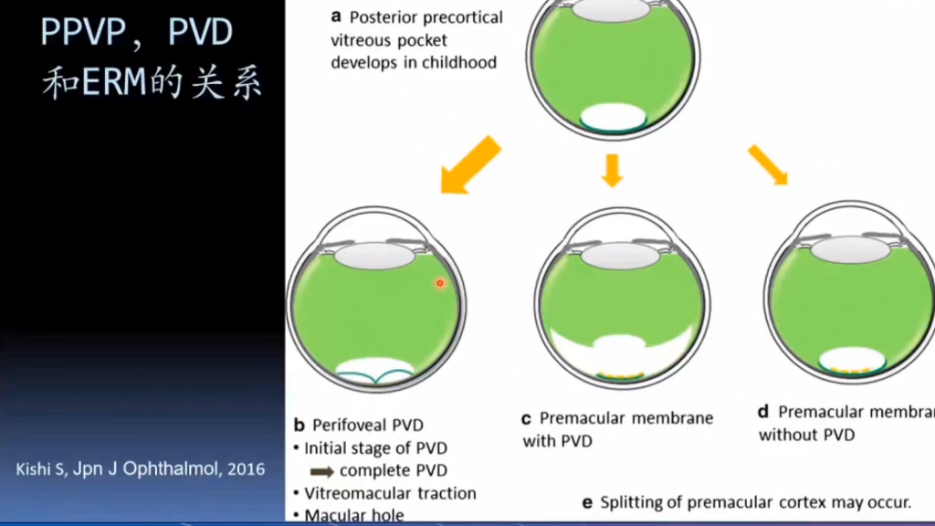 一语醍醐之玻璃体后皮质与黄斑前膜的关系哔哩哔哩bilibili