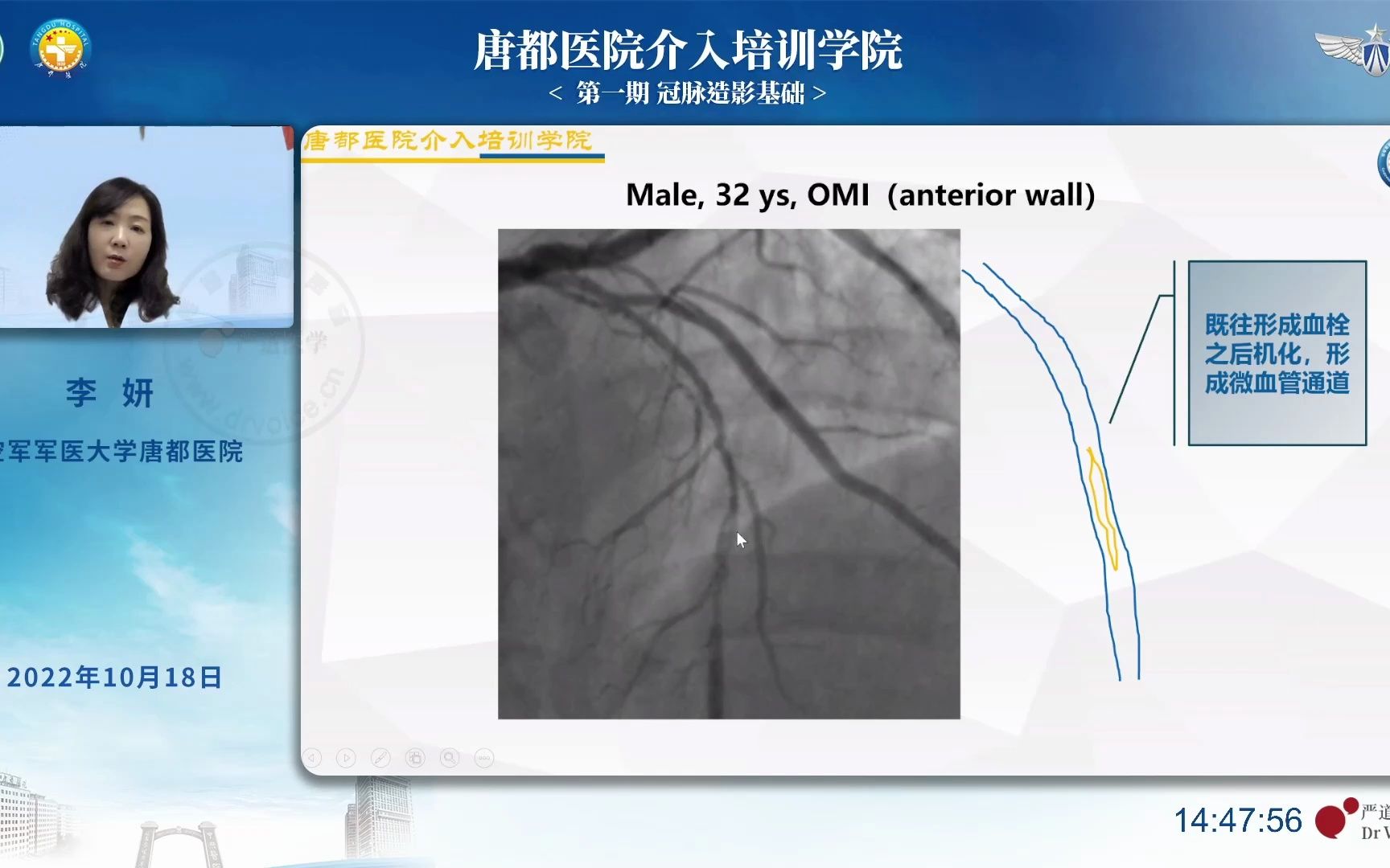 唐都医院介入培训学院 第一期 冠脉造影基础冠脉造影异常影像识别哔哩哔哩bilibili