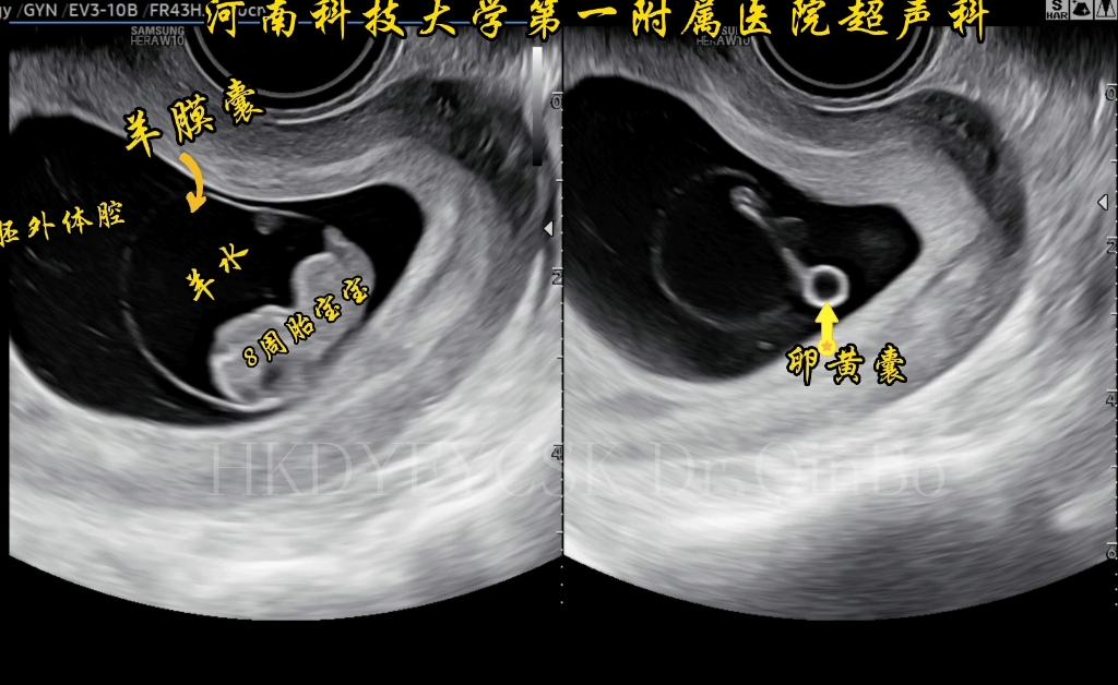 胎宝宝 绒毛膜隆起