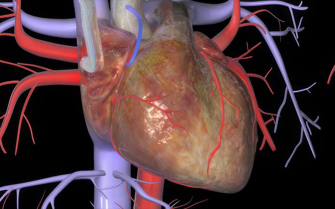 [图]心脏搭桥手术（CABG）动画演示